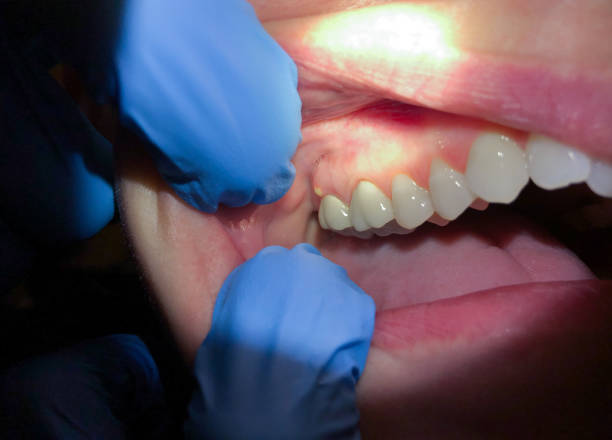 Best Chipped Tooth Repair Near Me  in Tompkinsville, KY